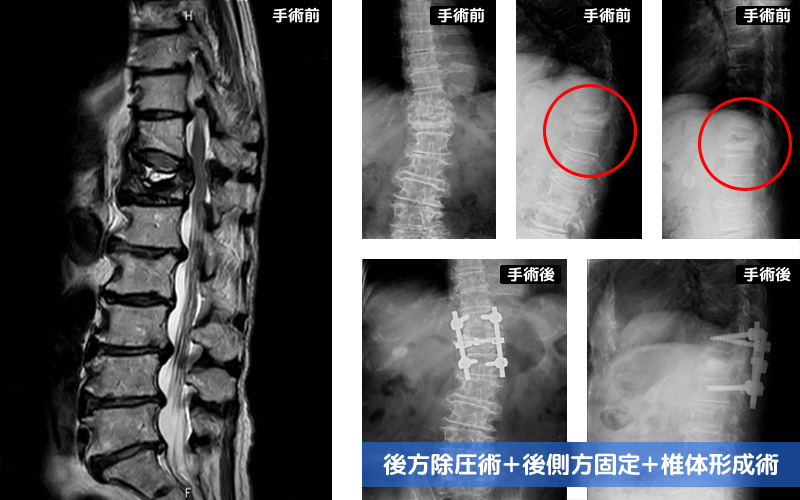 T12圧迫骨折後偽関節による脊髄円錐部不全麻痺